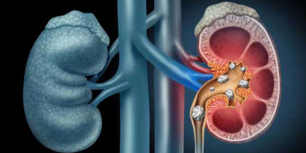 Stop eating these foods to avoid kidney stones
