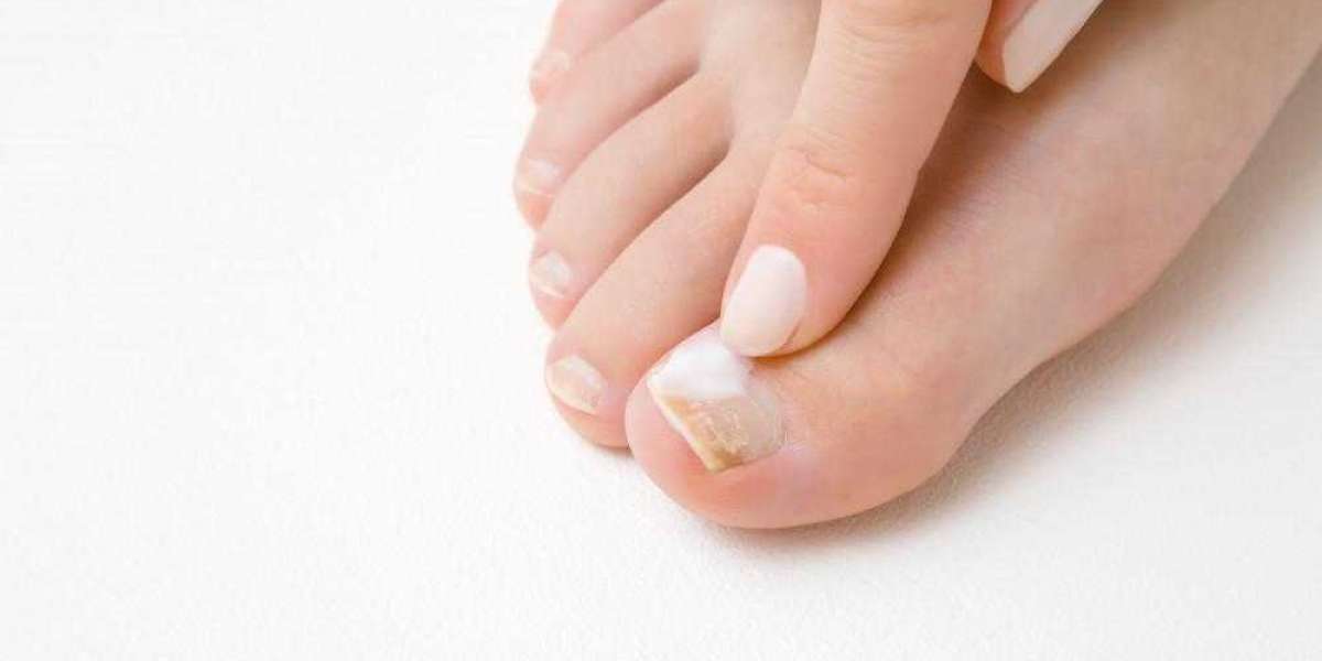 https://www.outlookindia.com/outlook-spotlight/kerassentials-toenail-fungus-treatment-oil-side-effects-and-shocking-resu